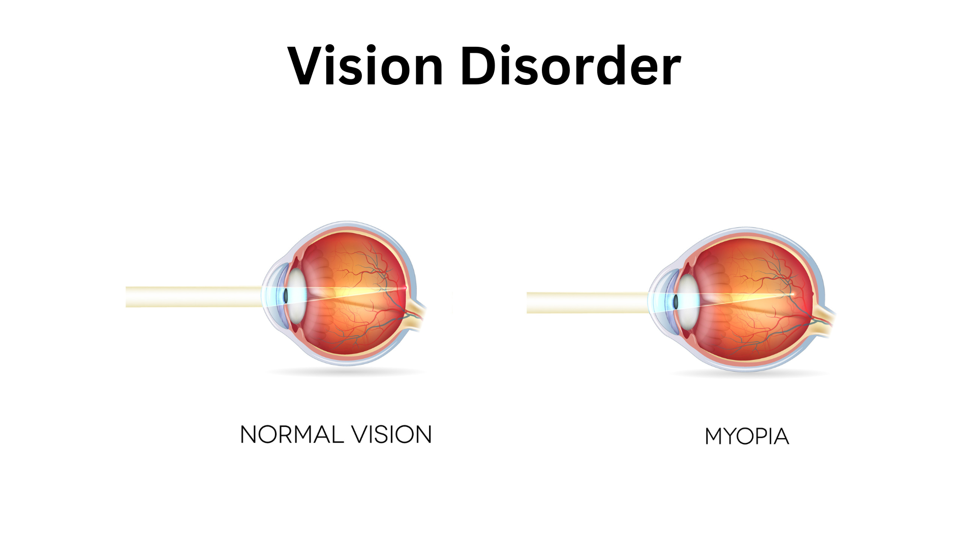 myopia